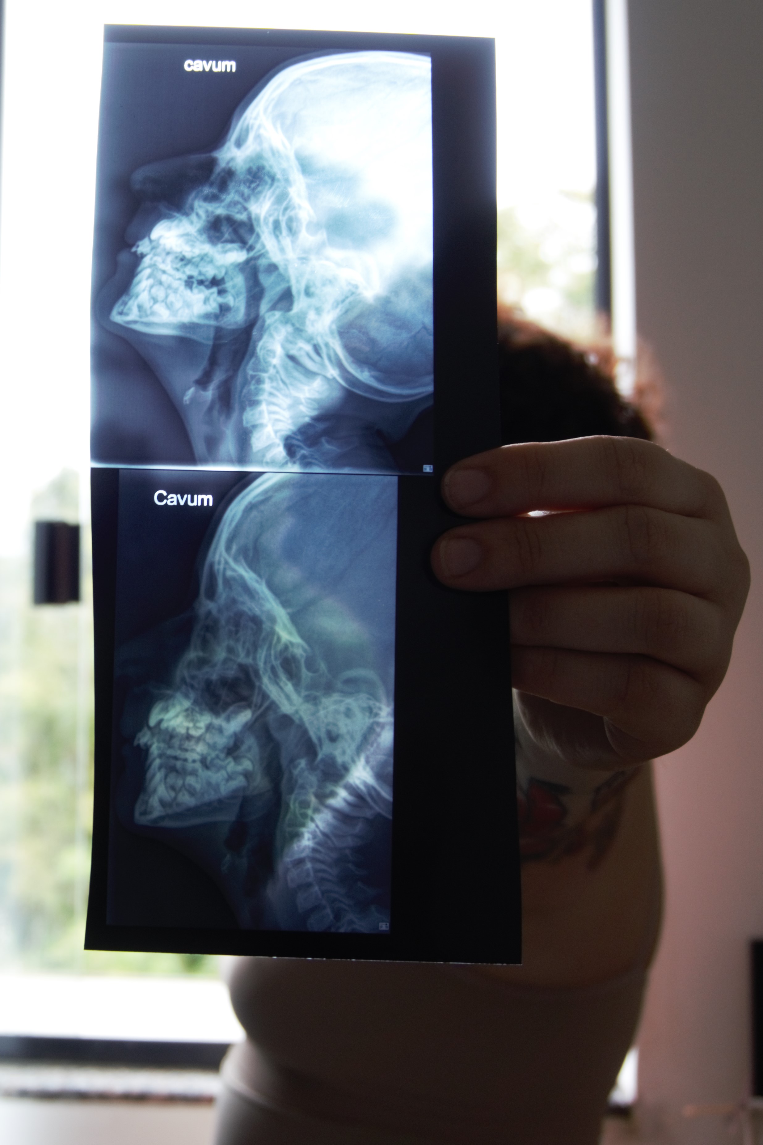 Próximo a câmera, um Raio X de face aparece, logo atrás o rosto de Nathi está de perfil.