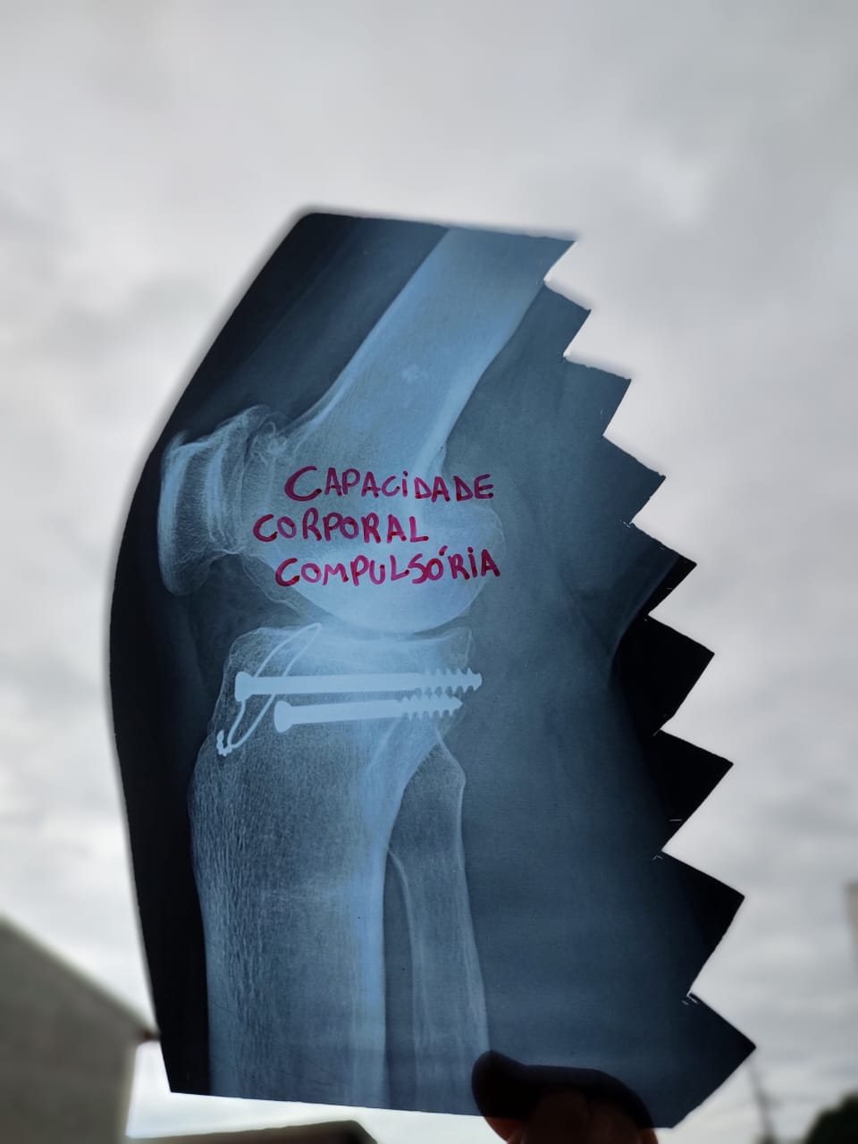 Raio X de joelho com parafusos aparecendo, a folha é cortada lateralmente como um serrote. Em letras vermelho escrito: Capacidade corporal compulsória.